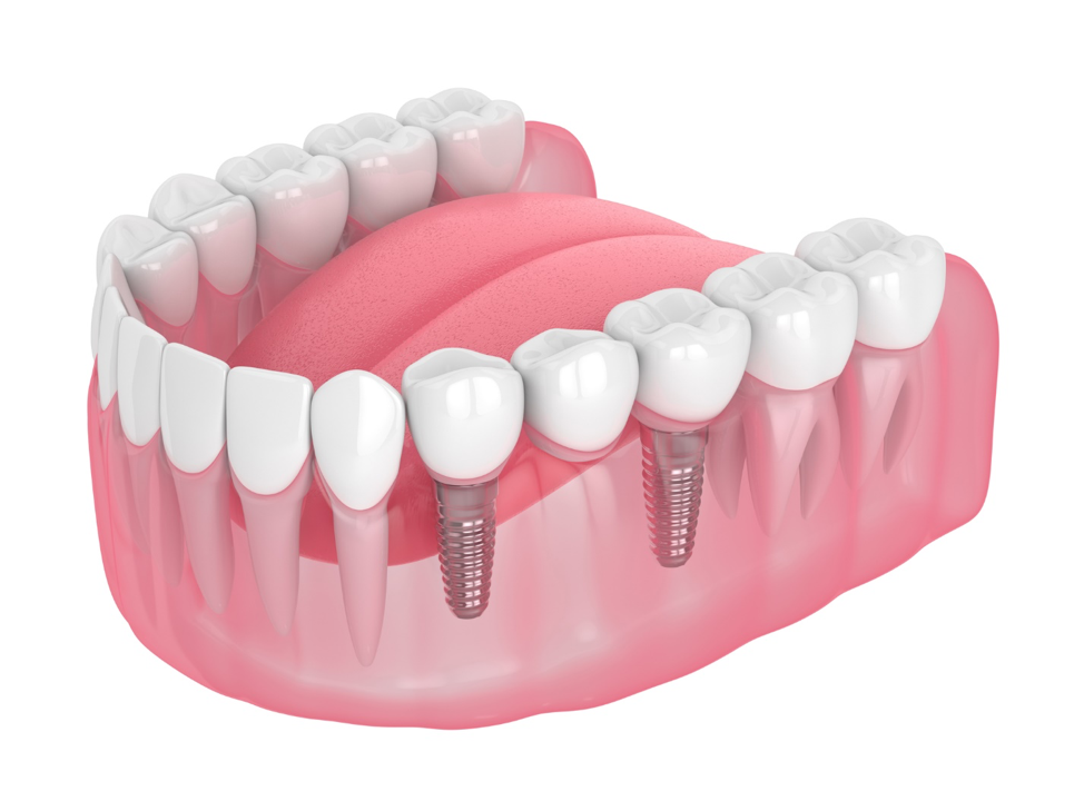 Implant supported bridges