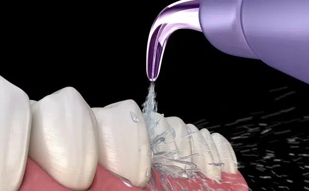 Step 3: Surface Conditioning for Enhanced Bonding