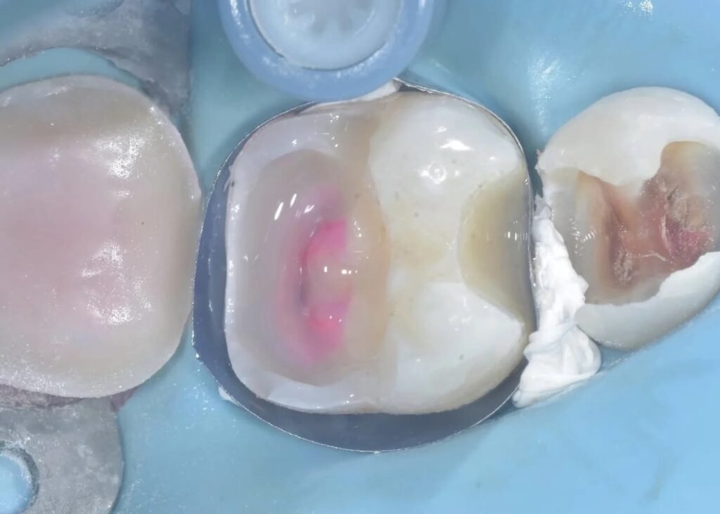 Step 4: Immediate Dentin Sealing