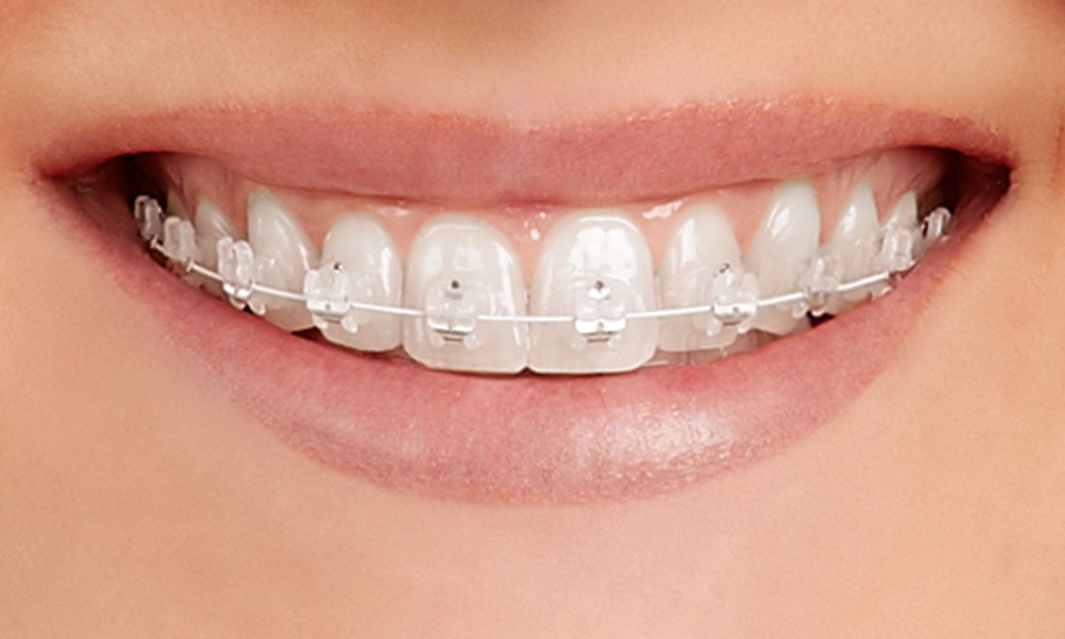 Self-Ligating ceramic Braces