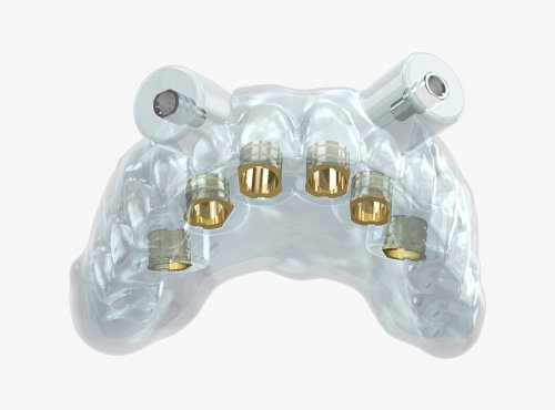 Guided implant surgery