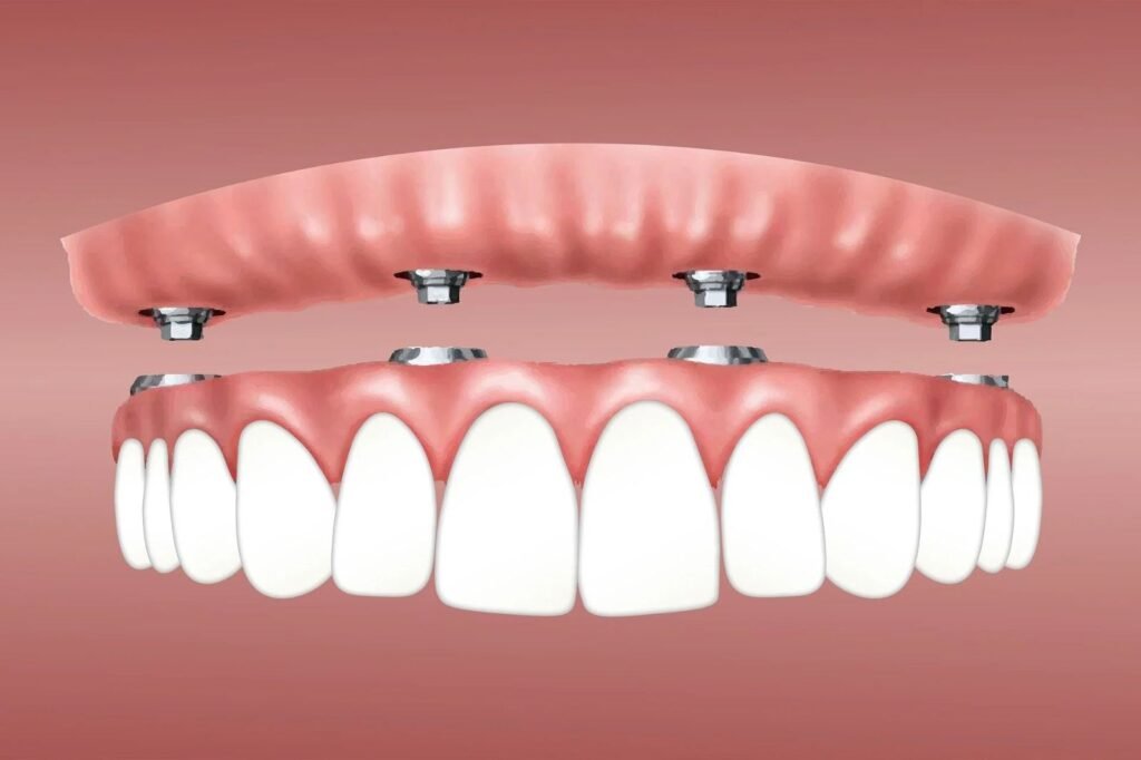 Implant-Supported Removable Overdentures