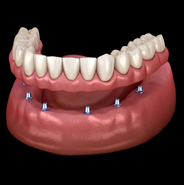 Implant-Supported Fixed Dentures