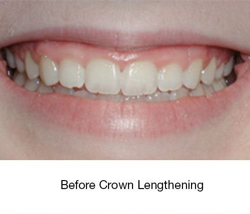 Before Crown Lengthening