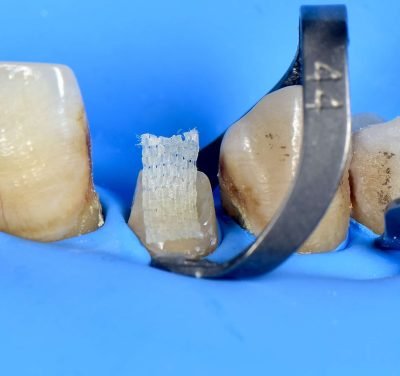 Step 6: Internal Reinforcement (Bio-Base Creation)
